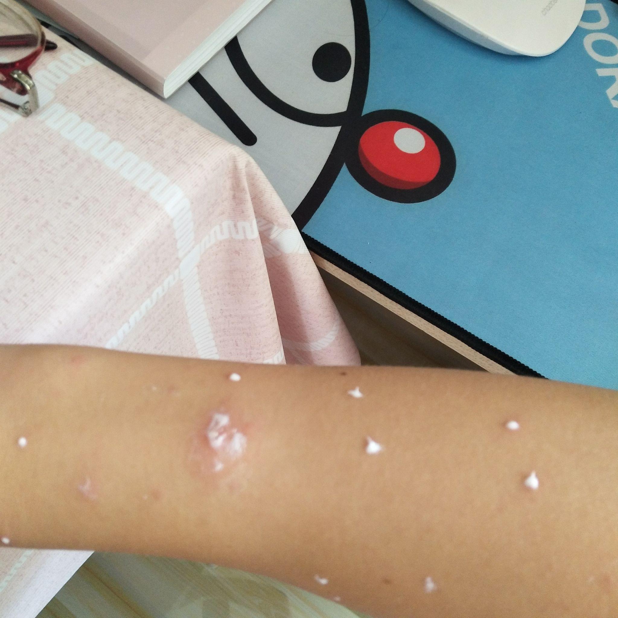 成人长水痘是什么样的经历? - 知乎