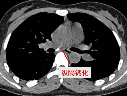 肺部陰影不一定是肺炎或肺癌還有這致殘性高的肺部疾病