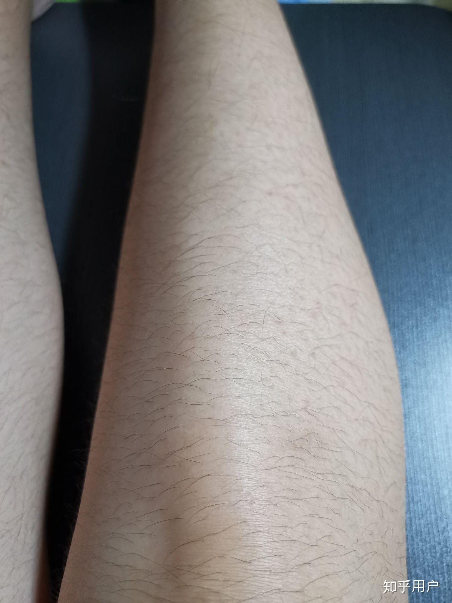 女生肚子上长毛怎么办