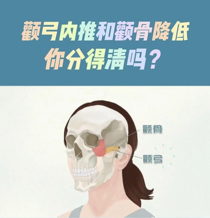 颧弓内推和颧骨降低你分得清吗? - 知乎