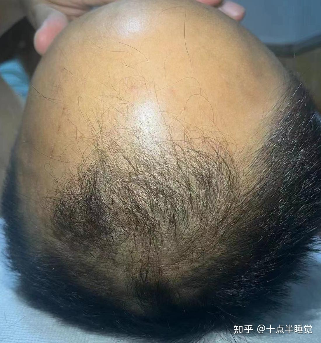 我的植发经历 - 知乎