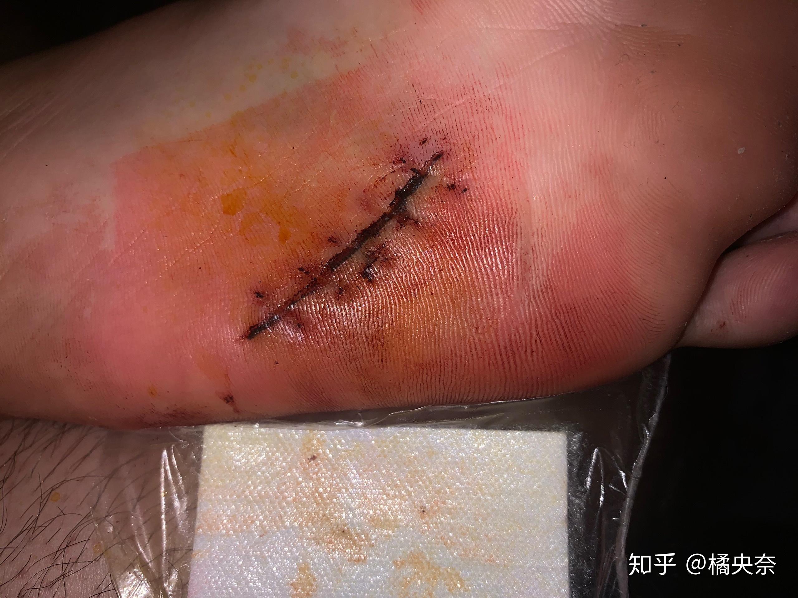 缝针和拆线可怕吗疼吗你们当时怕吗