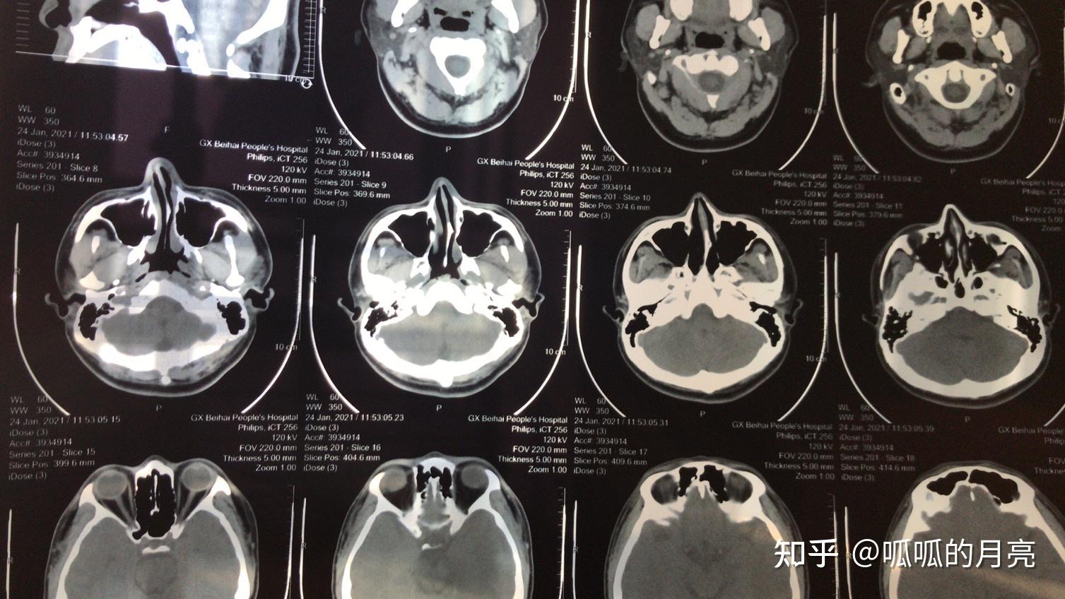 鼻中隔偏曲到什么程度才需要做手术