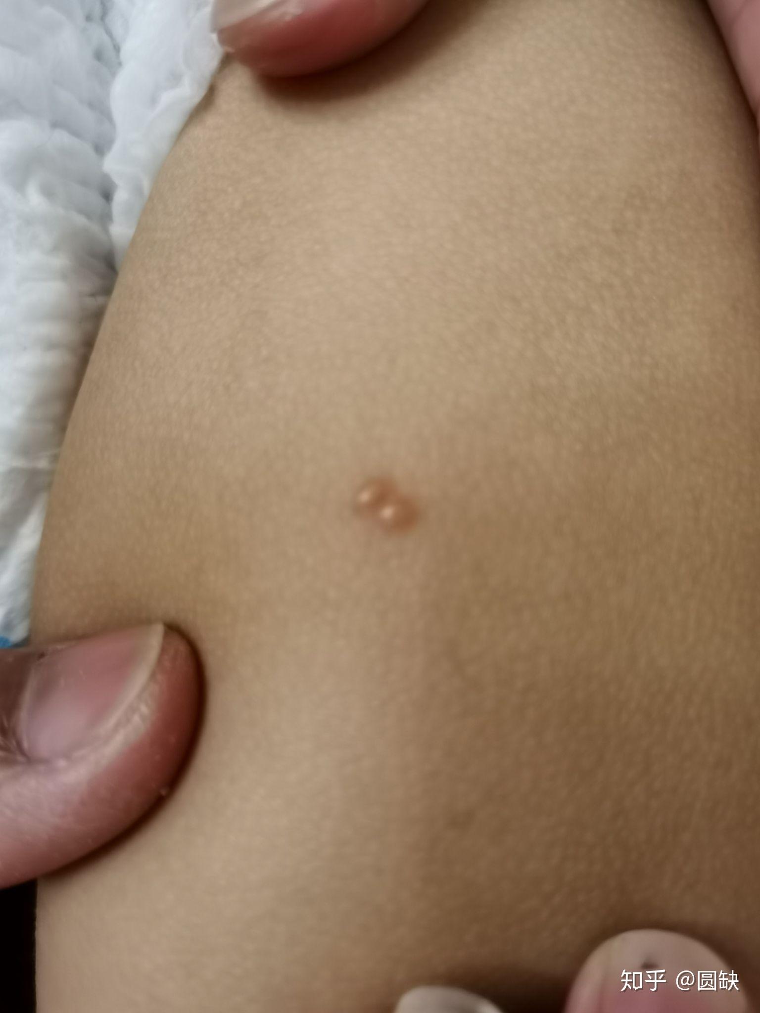 一岁孩子腿上长了两个水泡只有腿上有