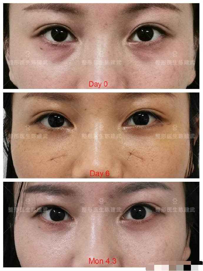 24岁美女玻尿酸泪沟填充失败,眼袋手术4个月后改变明显