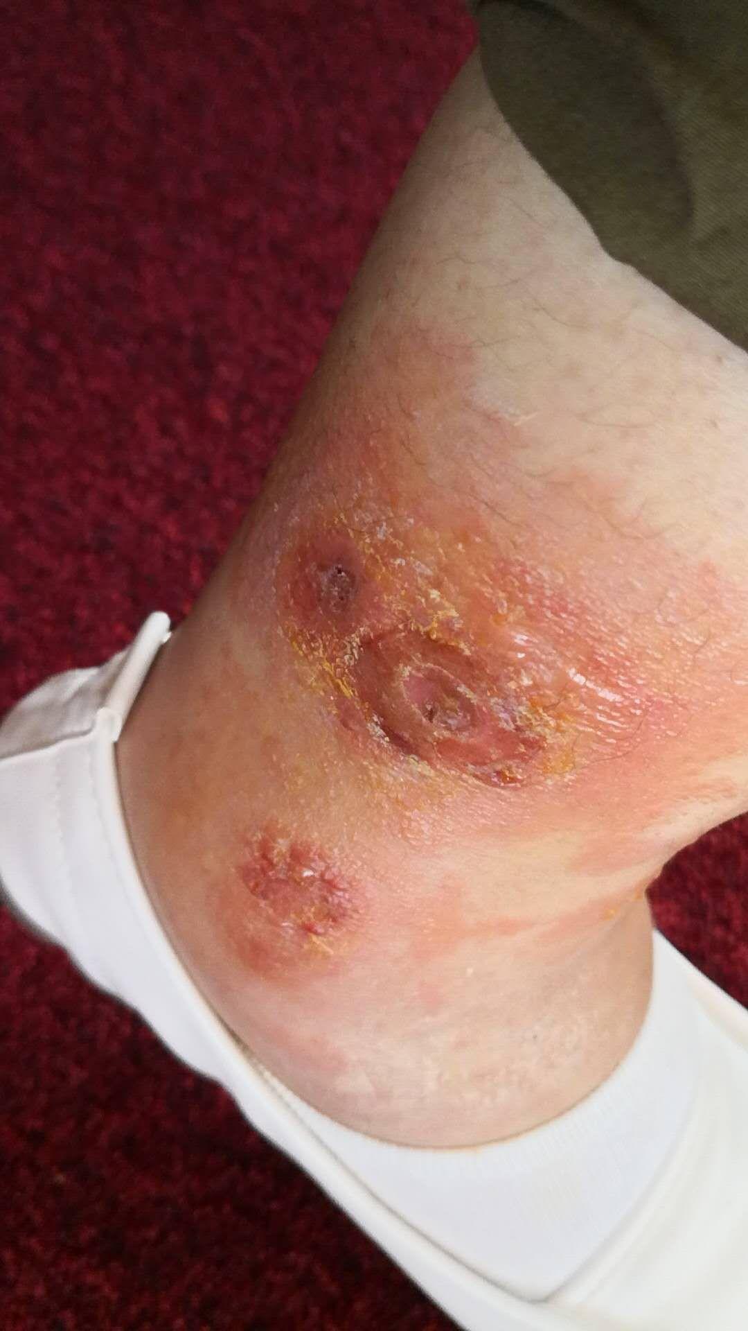 为什么被虫子咬的包会起水泡?