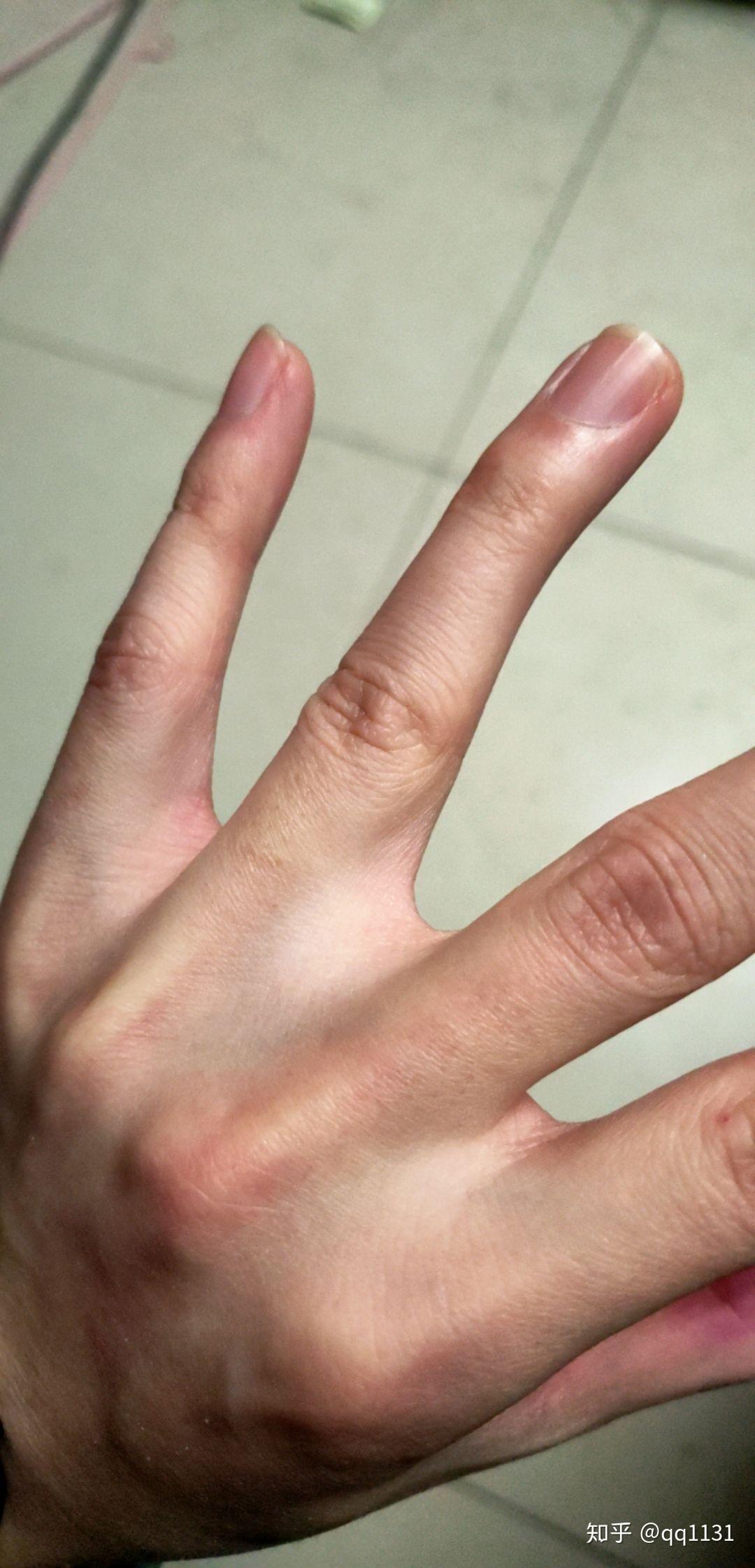手指之间有点像蹼的东西是什么?为什么我的比别人的大许多?