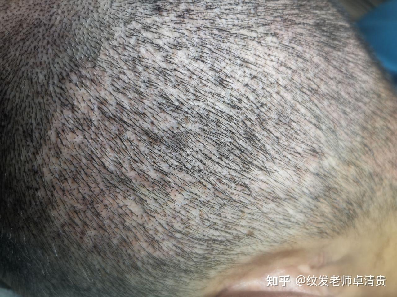 关于植发和纹发的一点看法 - 知乎
