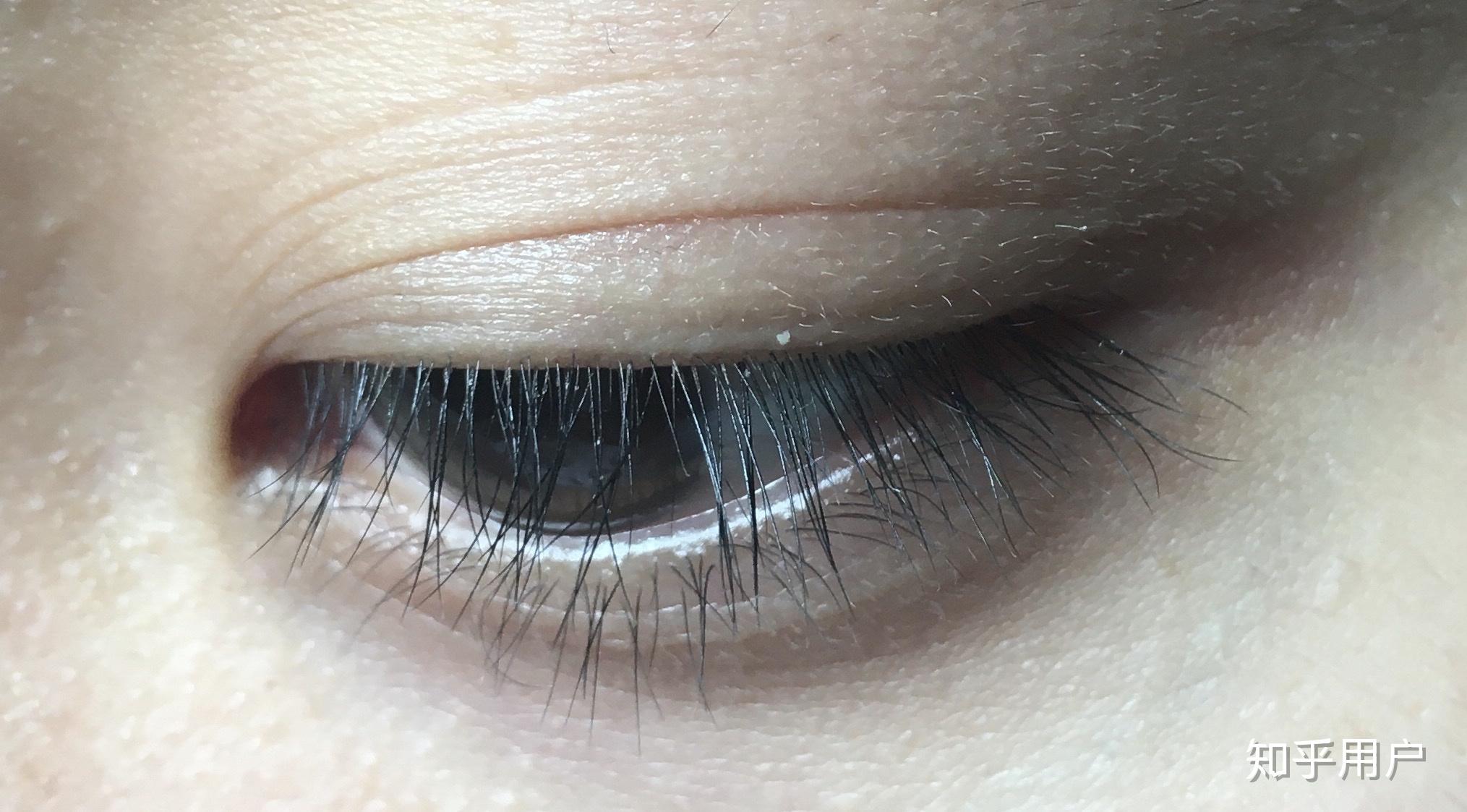 什么是双睫症?身边有这样的朋友吗? - 知乎