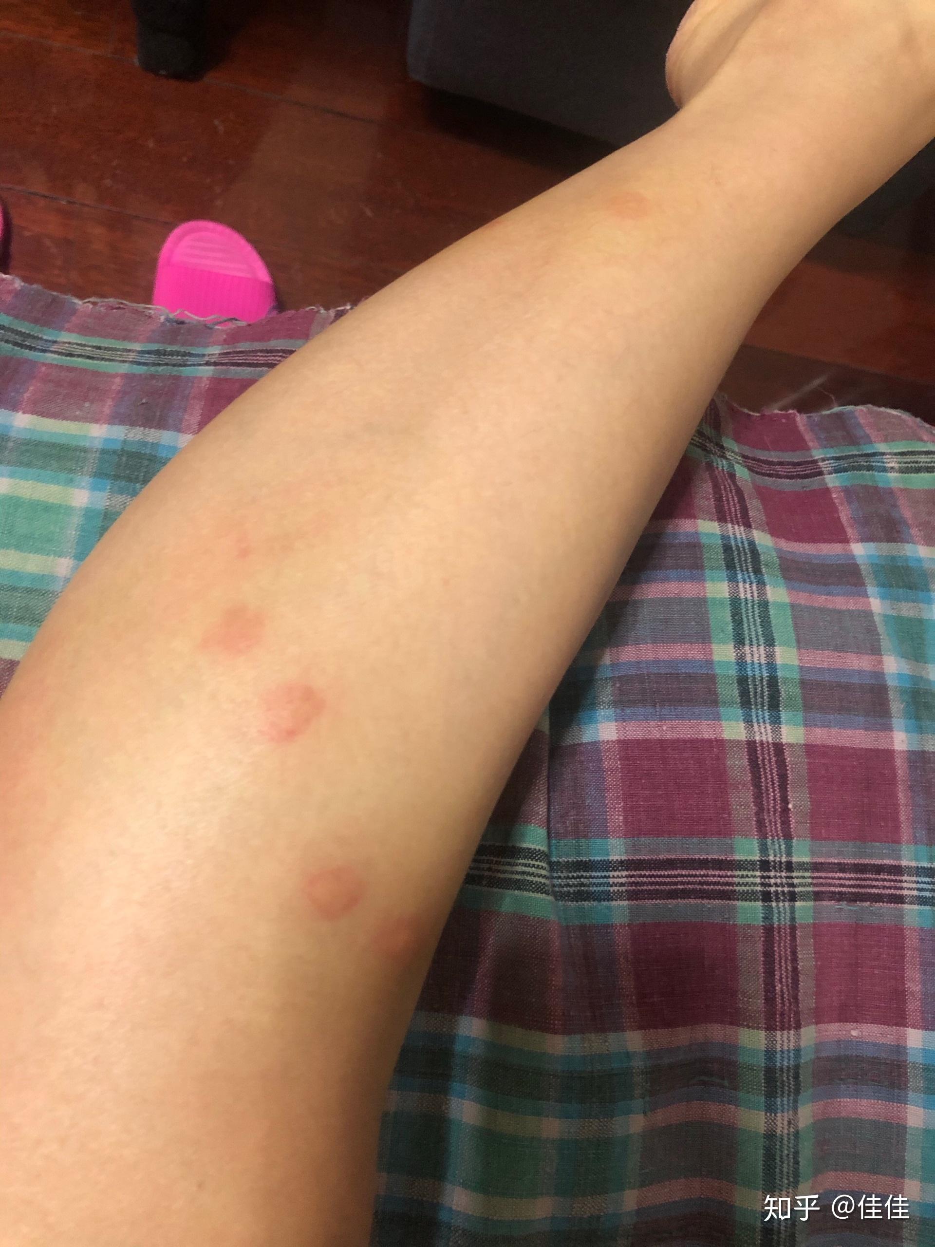 被跳蚤咬的全身都是包是什么样的感受! - 知乎