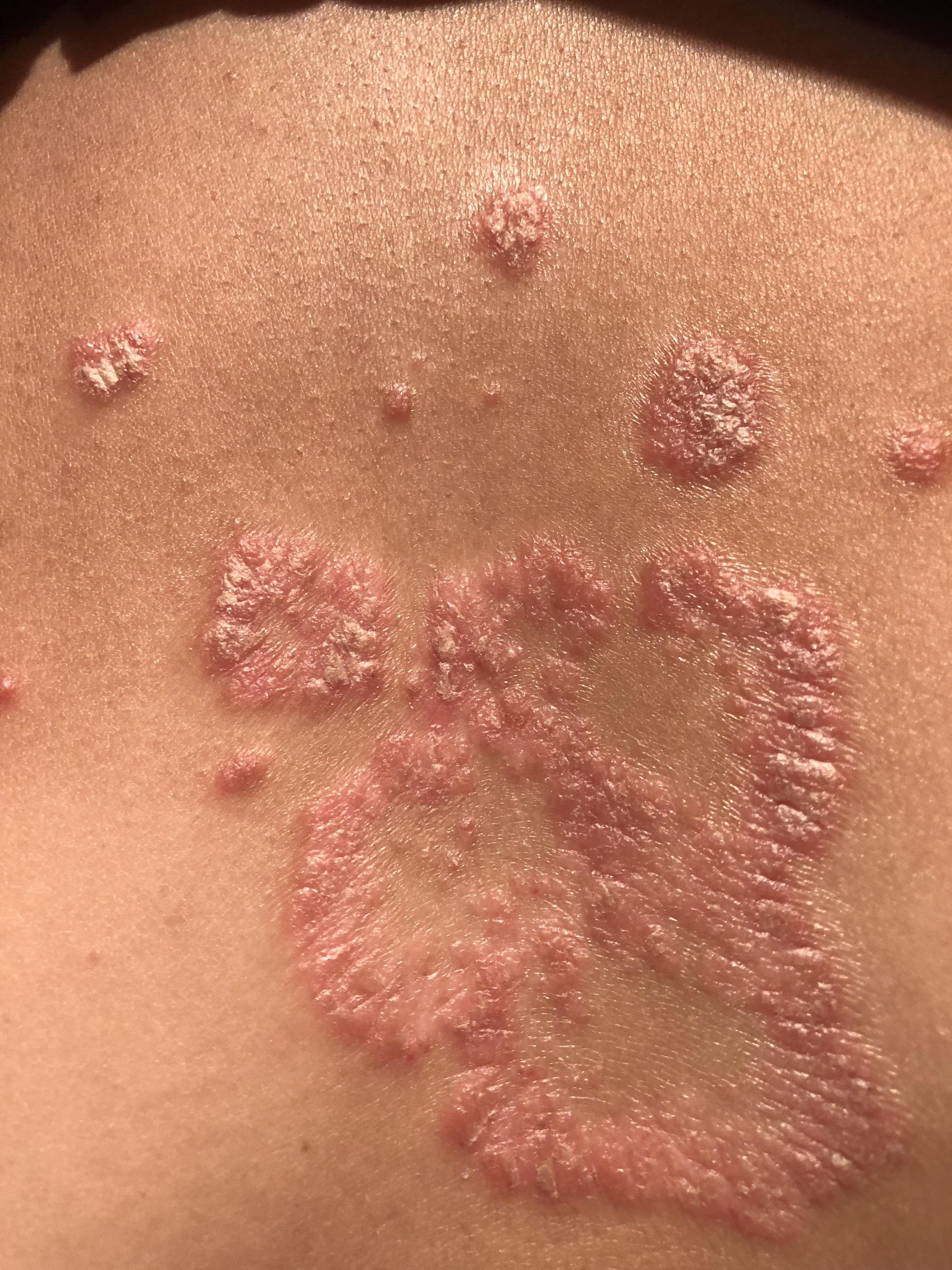 女生得了牛皮癣是一种什么体验能治好吗