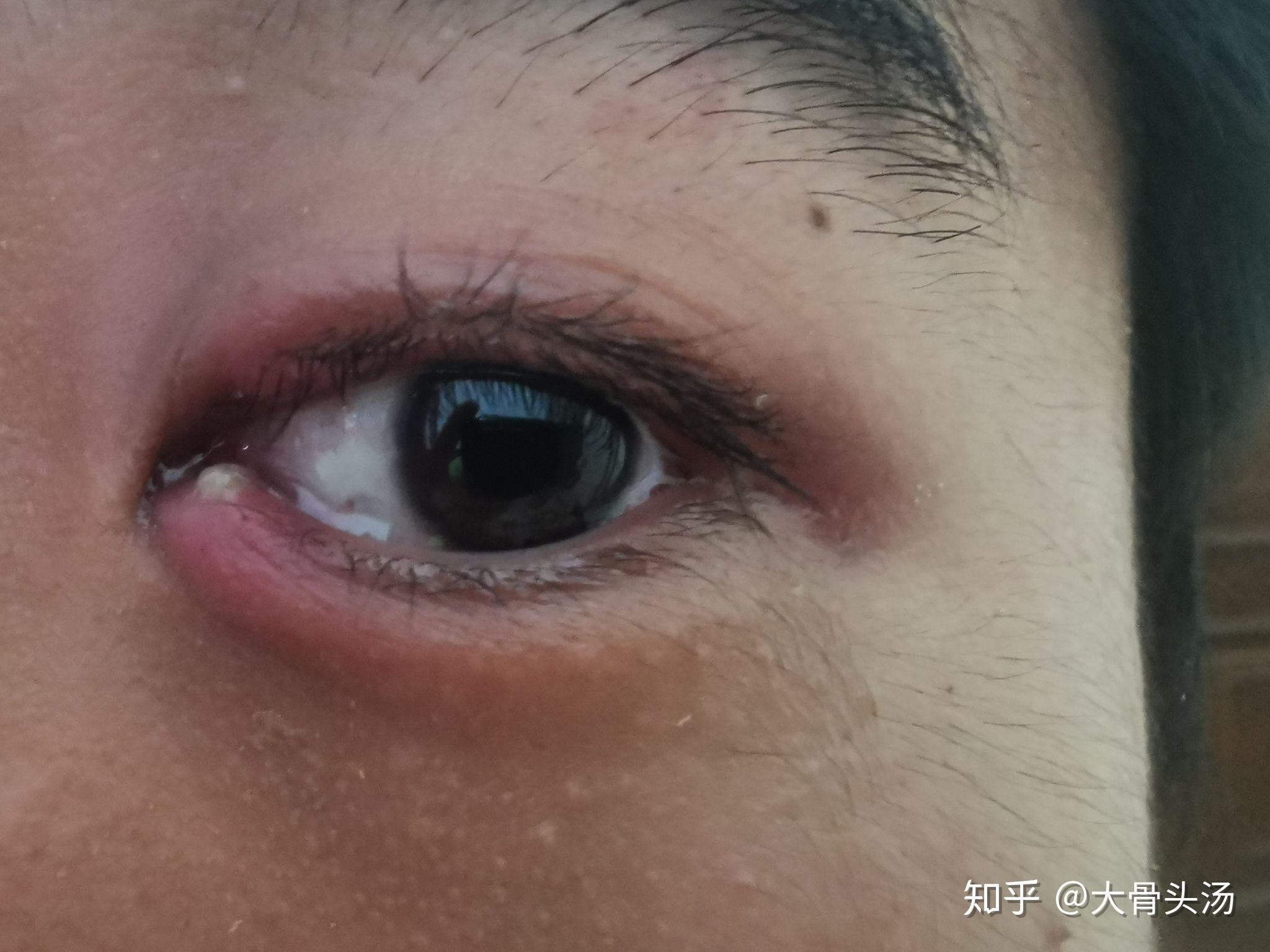 麦粒肿怎么较快恢复是外麦粒肿刚长起来