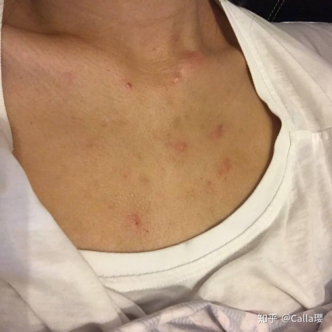 胸口上有鸡皮肤(胸前有鸡皮肤一样的症状)