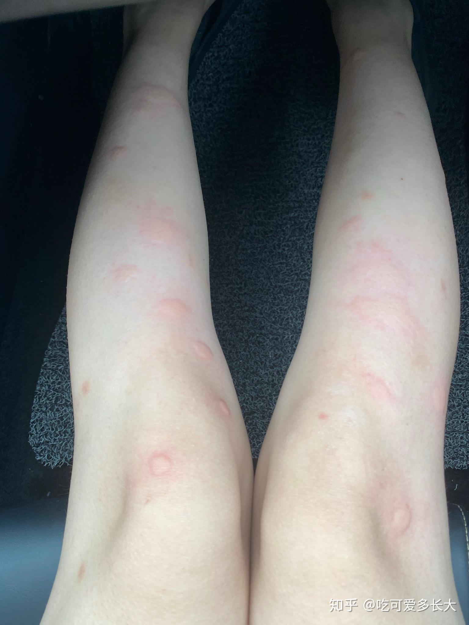 在南方被毒蚊子咬是一种怎样的体验