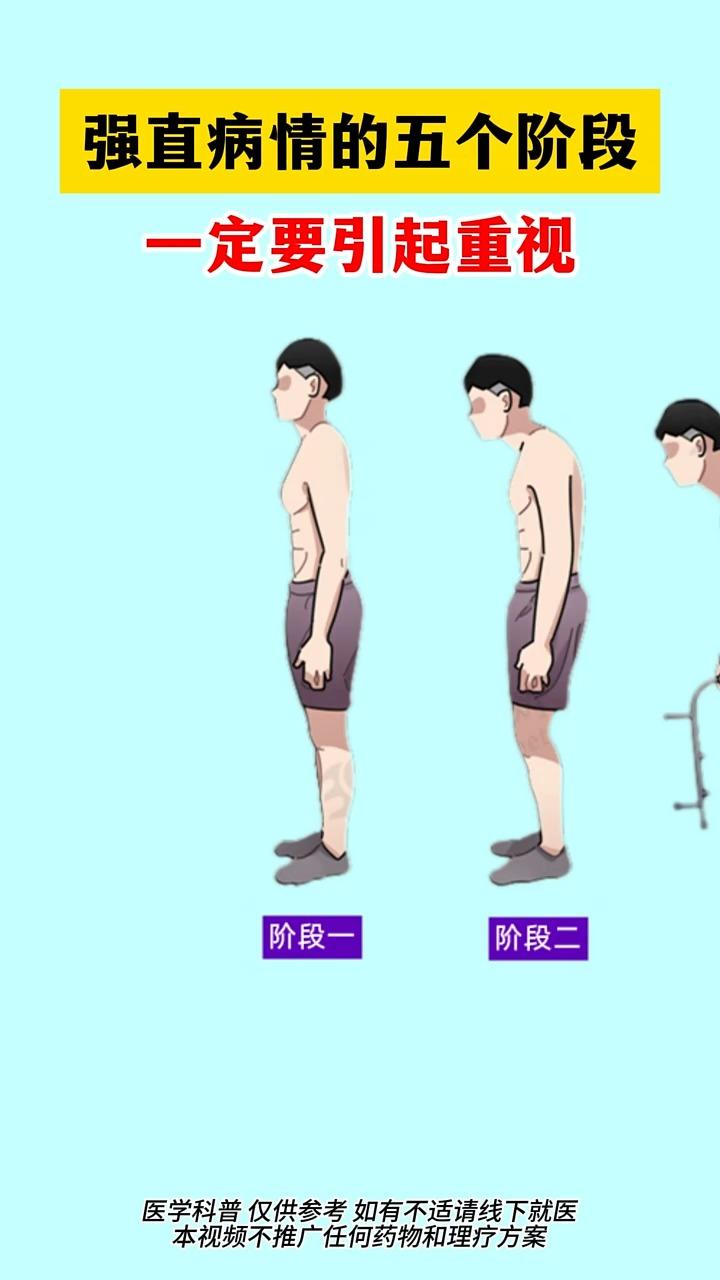 强直性脊柱炎的五个阶段