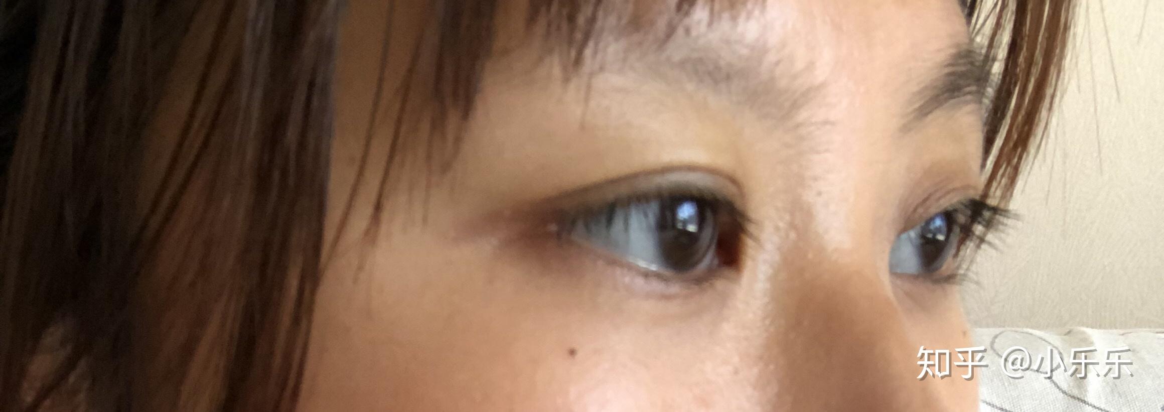 眼白发蓝想变白怎么治补血补铁就行吗