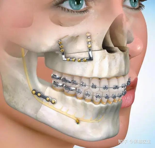 目前国内治疗下颌后缩的办法有哪些不想要单纯的整形想要功能性的治疗