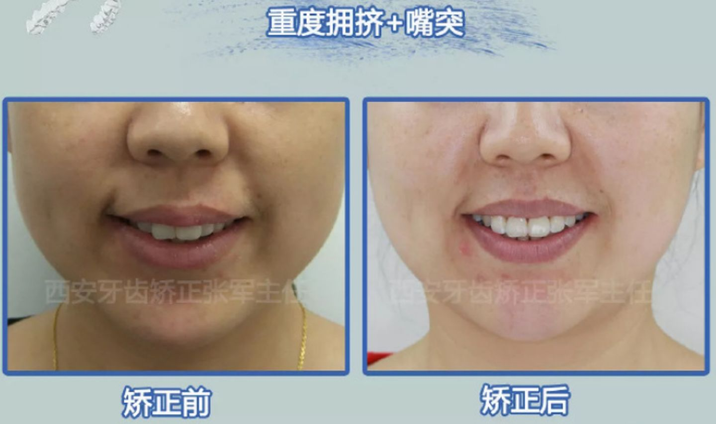 1 排齐和整平(以拔除上下颌第一前磨牙为例)-口腔正畸舌侧矫治-医学