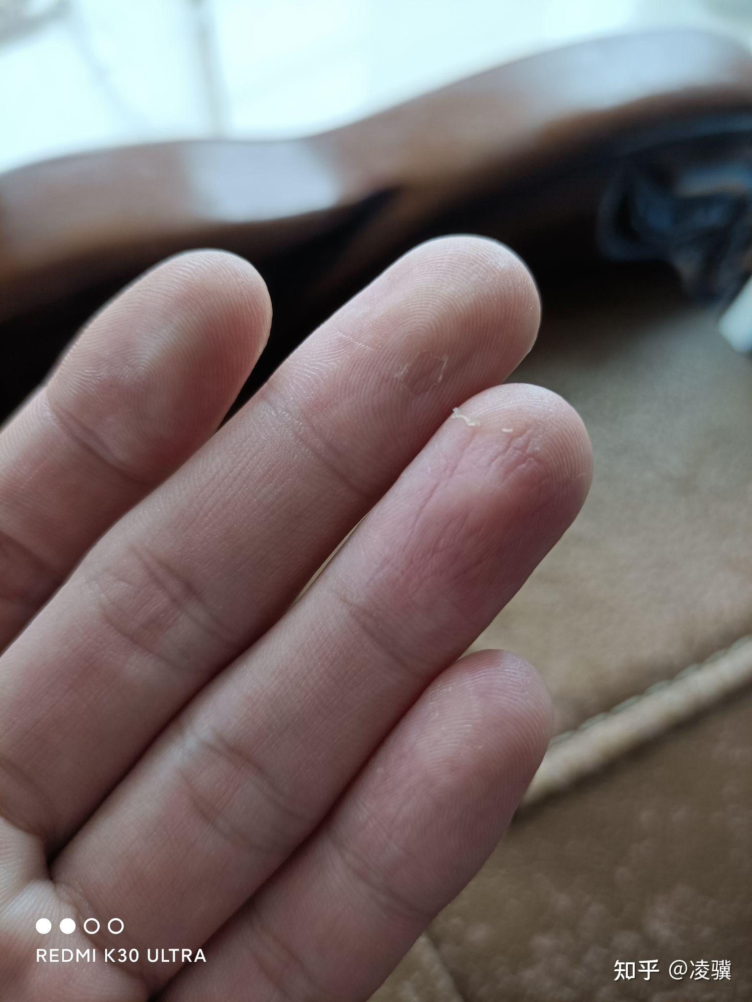 如何看待b站用户反映小米11打游戏被烫出水泡