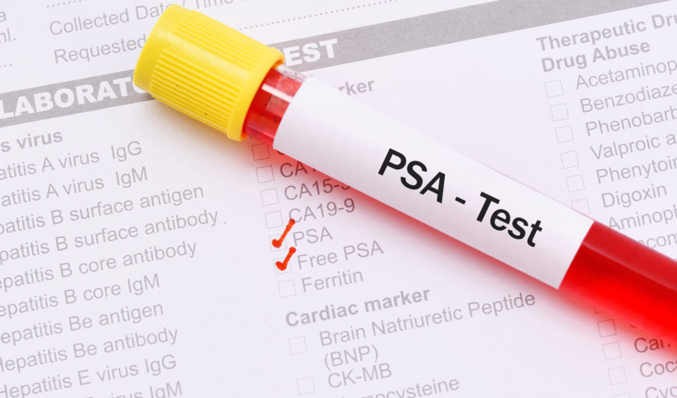 读懂化验单上的肿瘤标志物 Psa值与前列腺癌的那些事 知乎