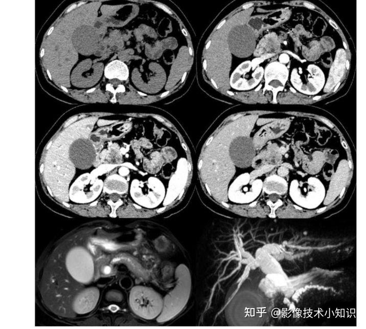 胰腺ct平扫图片图解图片