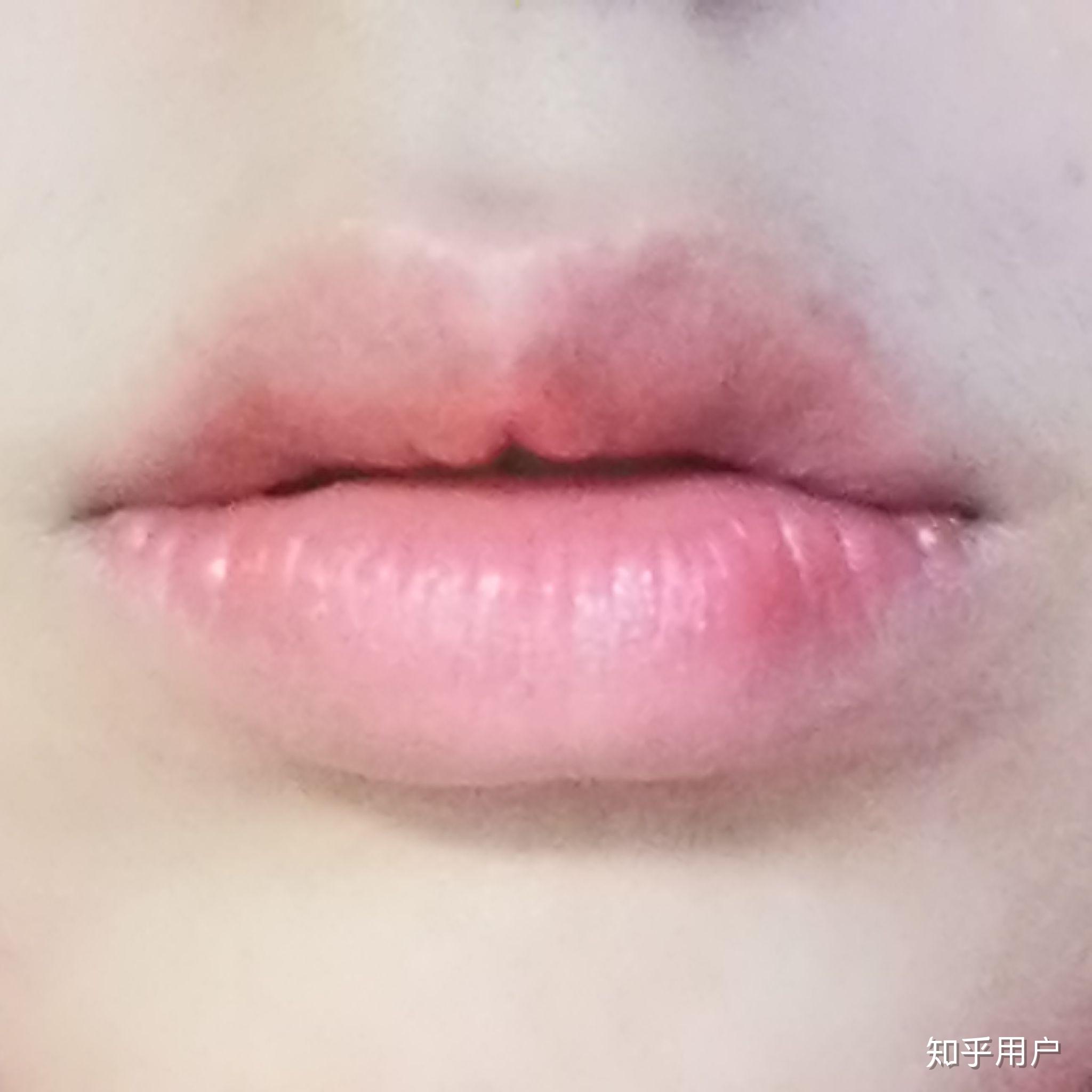 嘴唇很容易起皮经常咬结果本来长唇珠的位置凹进去一块 怎么办?