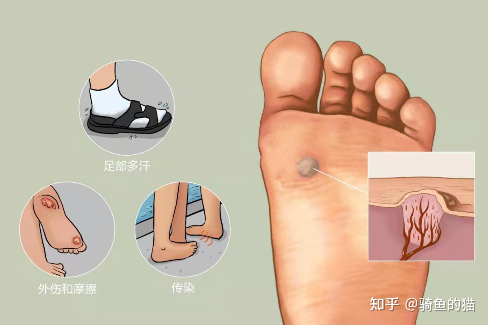 请求辨别是跖疣还是鸡眼