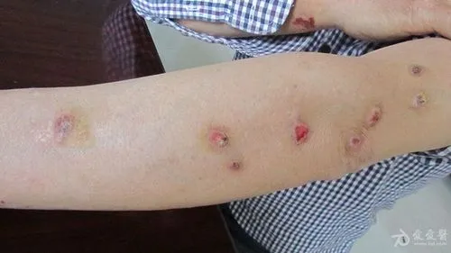 结节性痒疹结节很硬用什么药 - 知乎