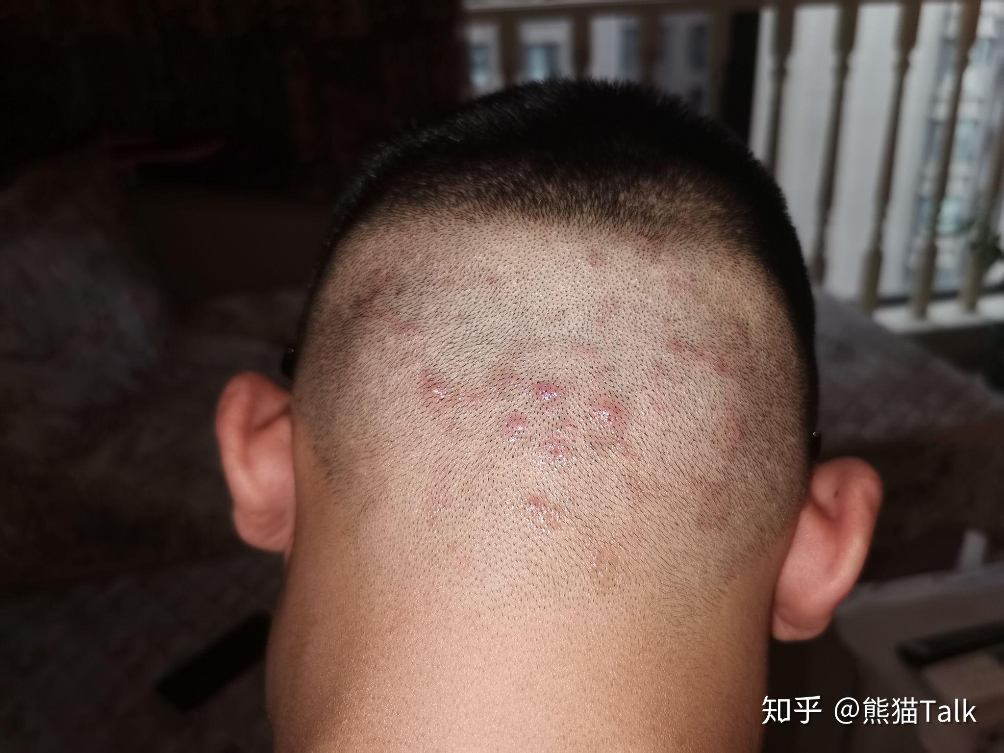 头皮上长痘痘是什么样的感觉? - 知乎
