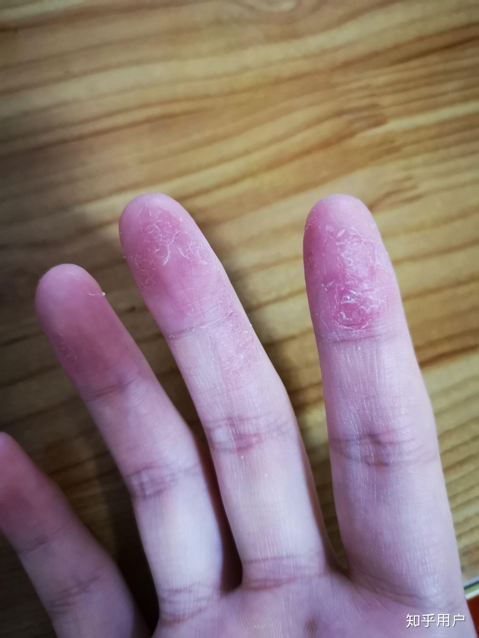 手指尖脱皮与气候季节的相关性是怎么形成的