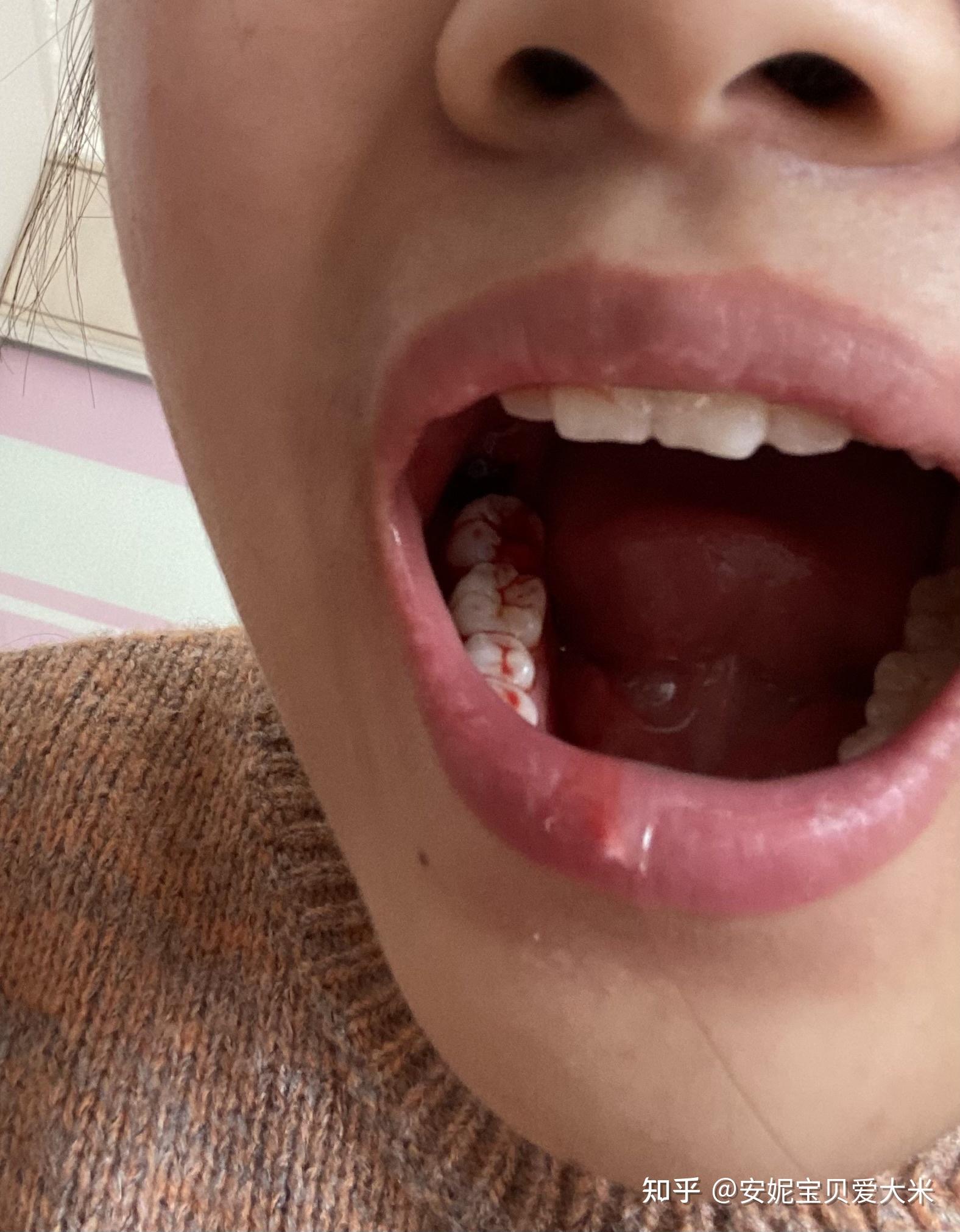 有一颗智齿一半长出来了一半在肉里位置正要拔吗