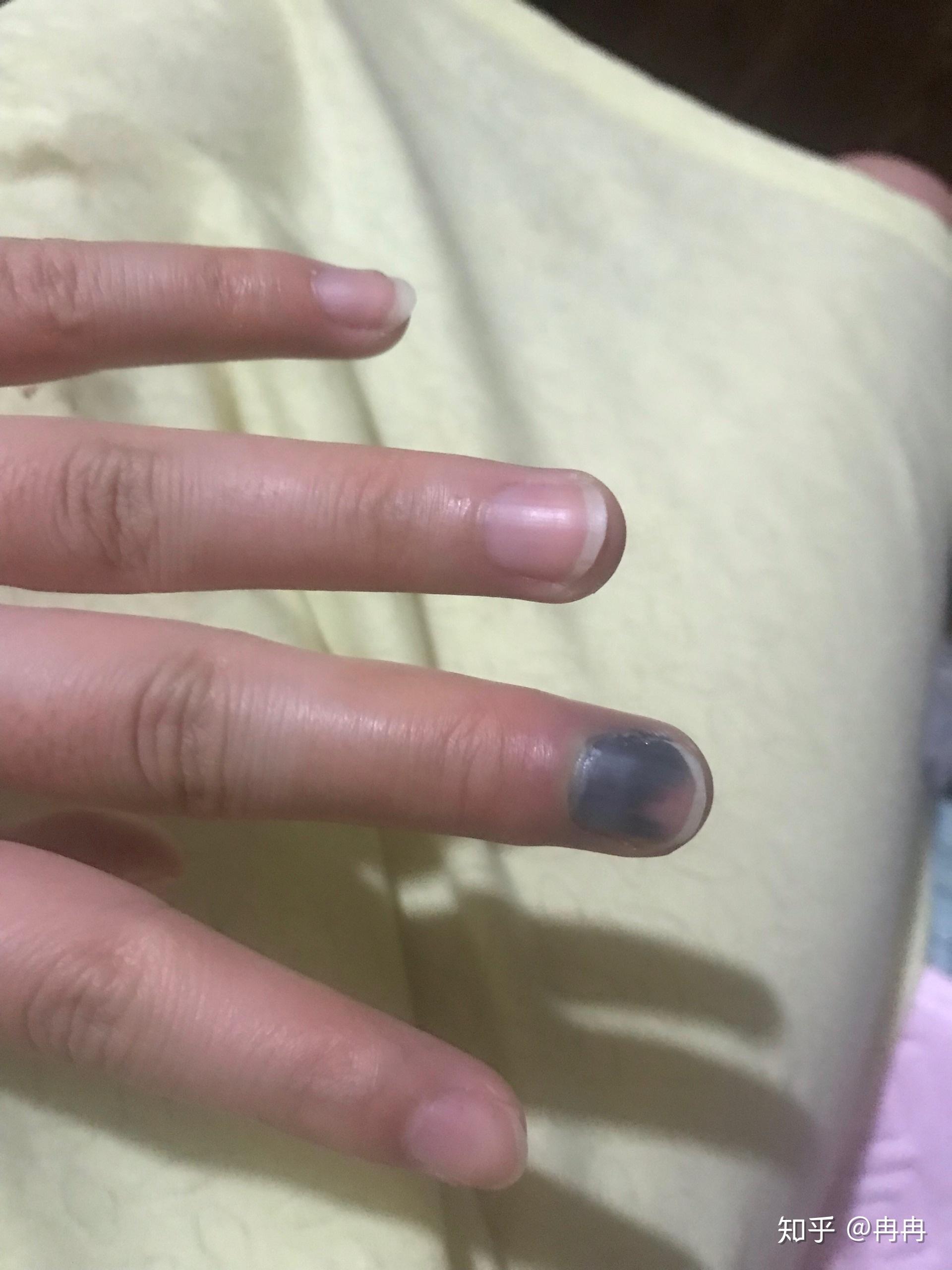 手指被门夹了,然后指甲里面四分之一有淤血,都两个月了还没好,怎么办?