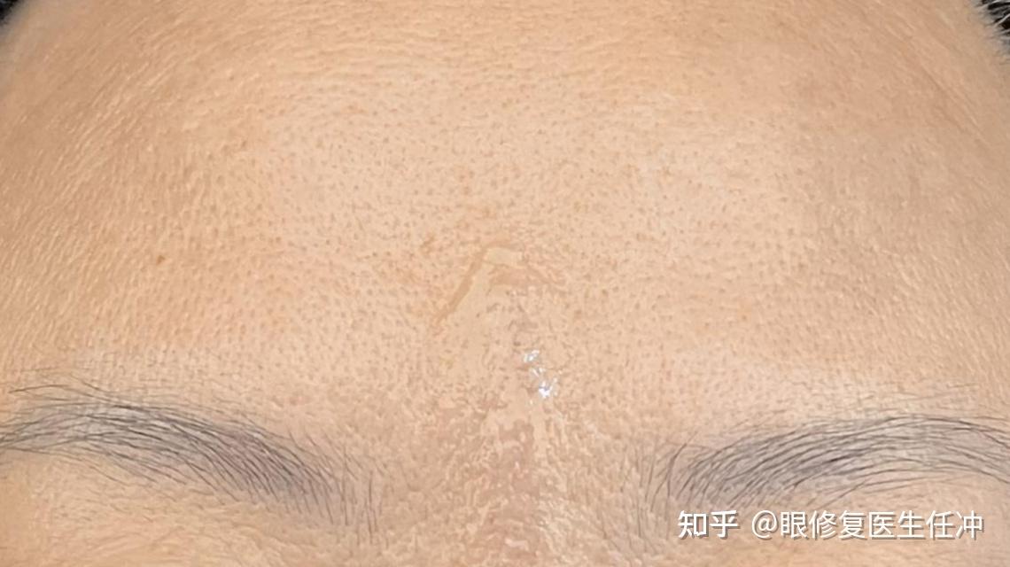 立于双眉间,竖穿印堂,人称"斩子纹",医生:有川字纹只是皱眉肌发达