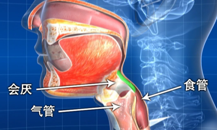 第二类容易患吞咽困难的人群：脑卒中患者 知乎