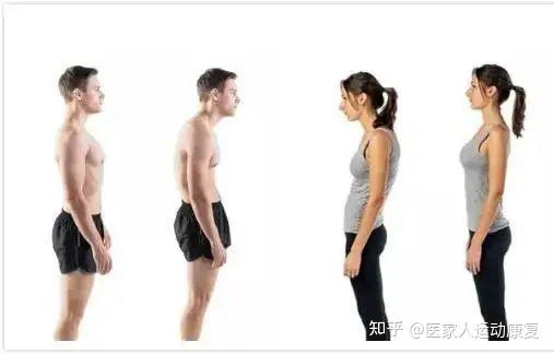 头前倾是如何形成的，该如何纠正呢？ - 知乎