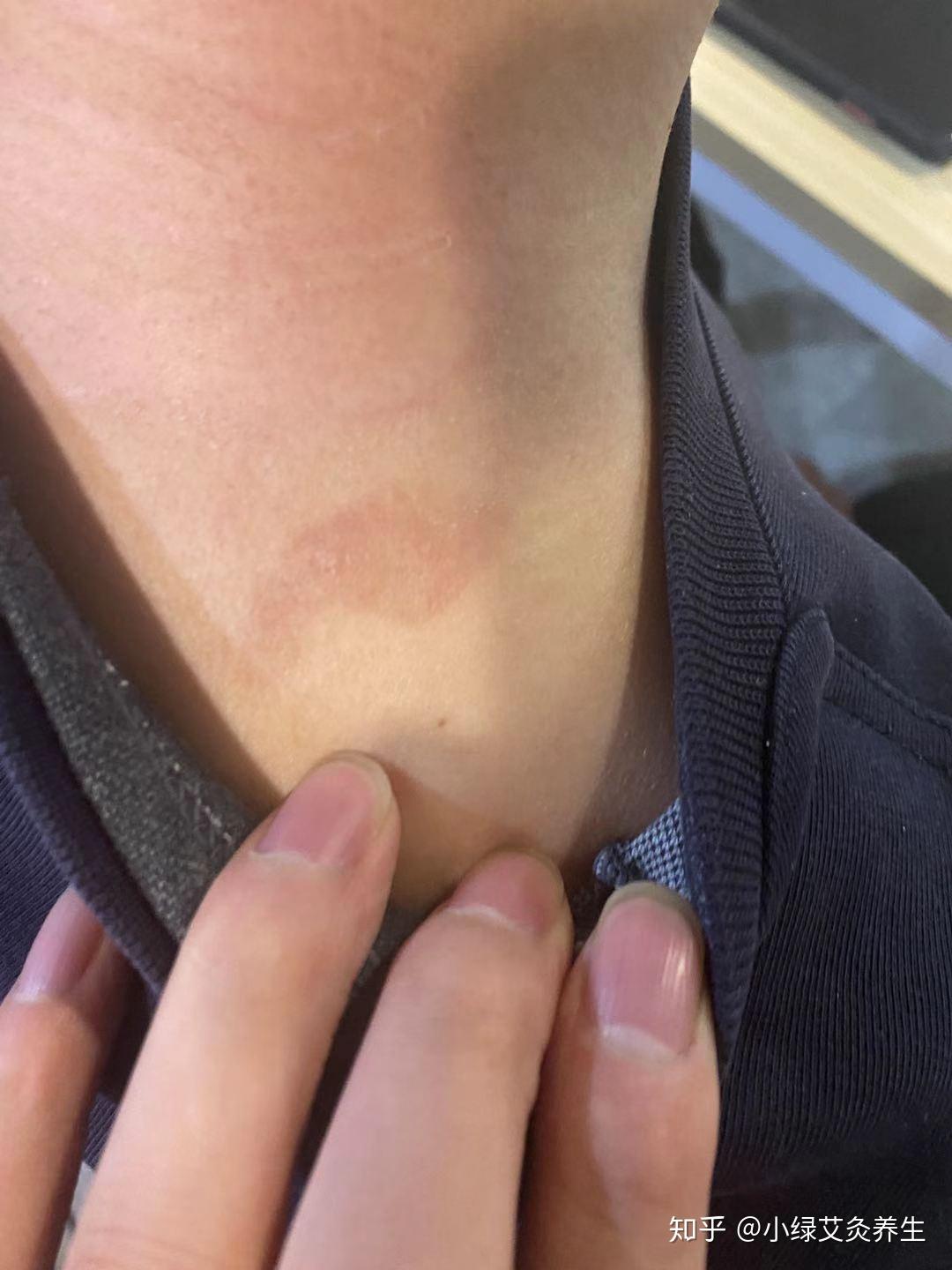 你们试过艾灸后出红疙瘩嘛