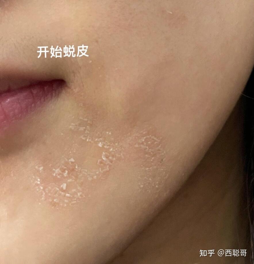 混油皮超级卡粉,起皮,浮粉怎么办?有无护肤品推荐? - 知乎