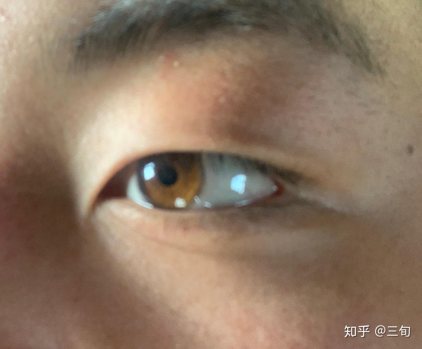 为什么有些中国人的眼睛是棕黄色的