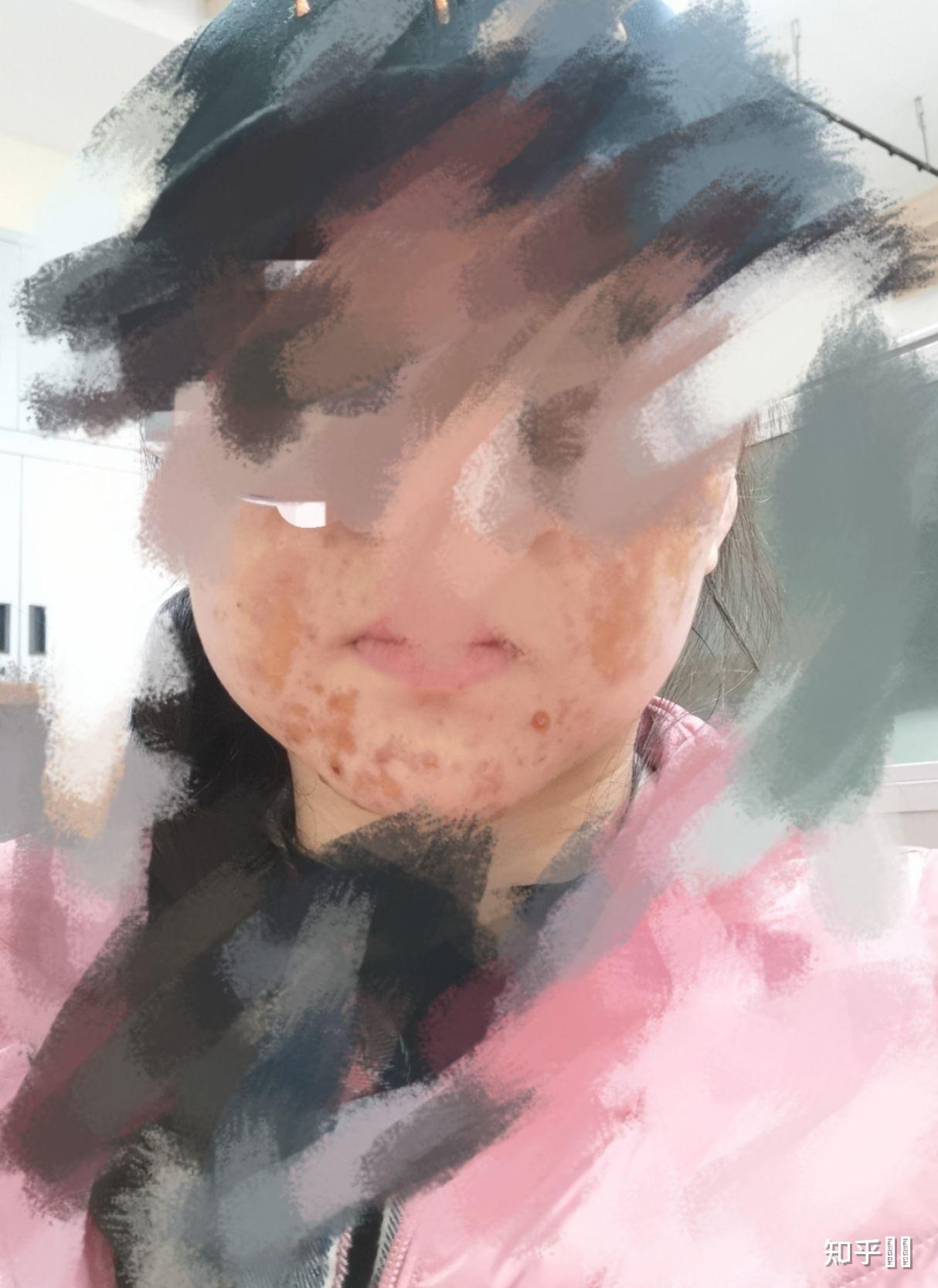 果酸灼伤是什么体验? - 知乎
