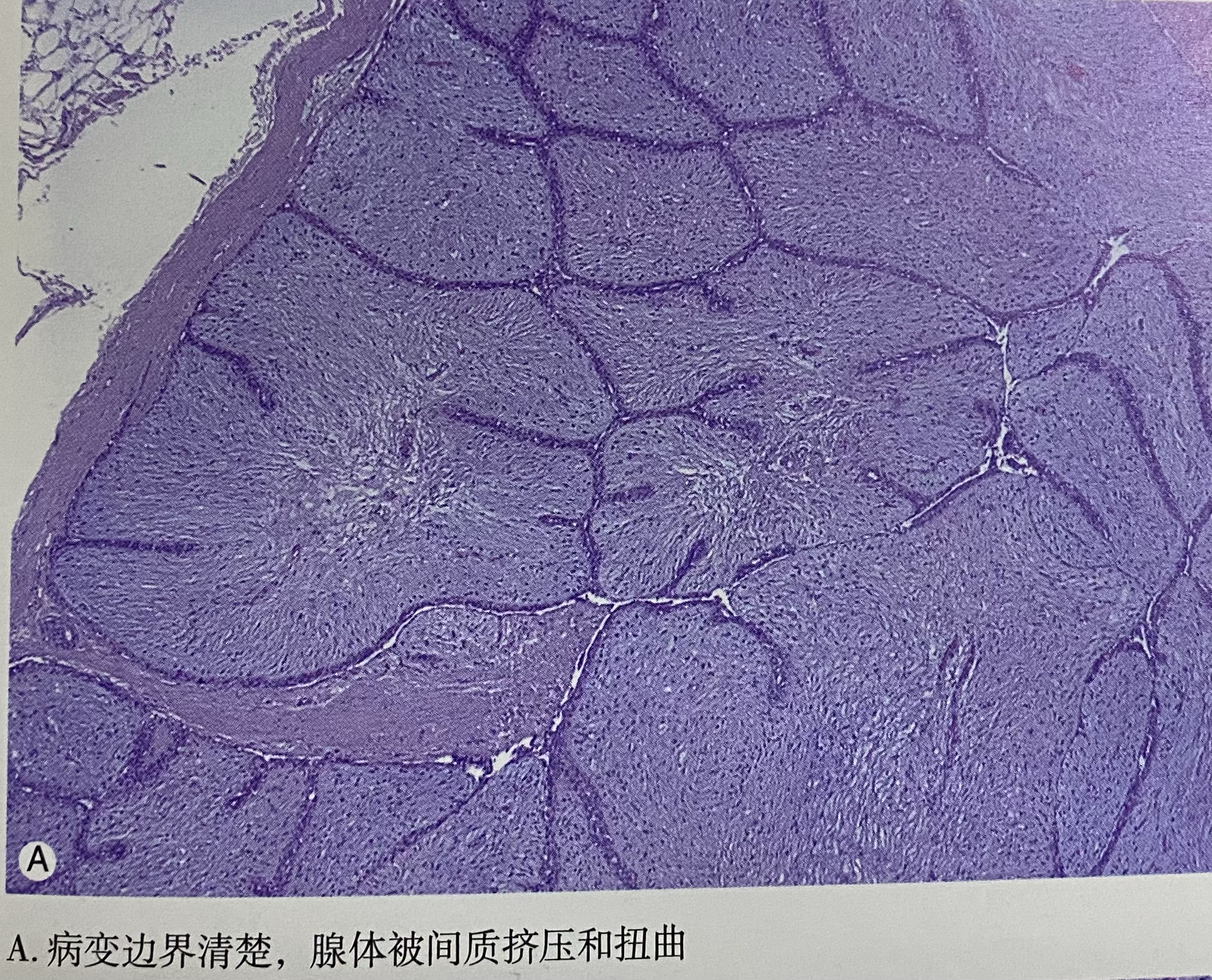 乳腺纤维腺瘤病理图片