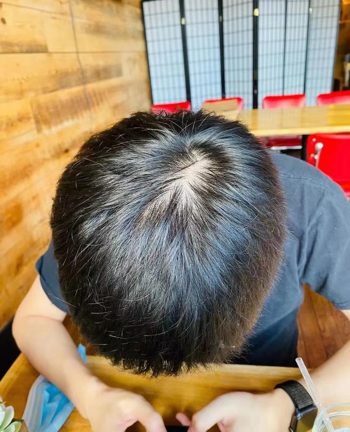 头顶开始稀疏是地中海秃头的前兆吗？ - 知乎