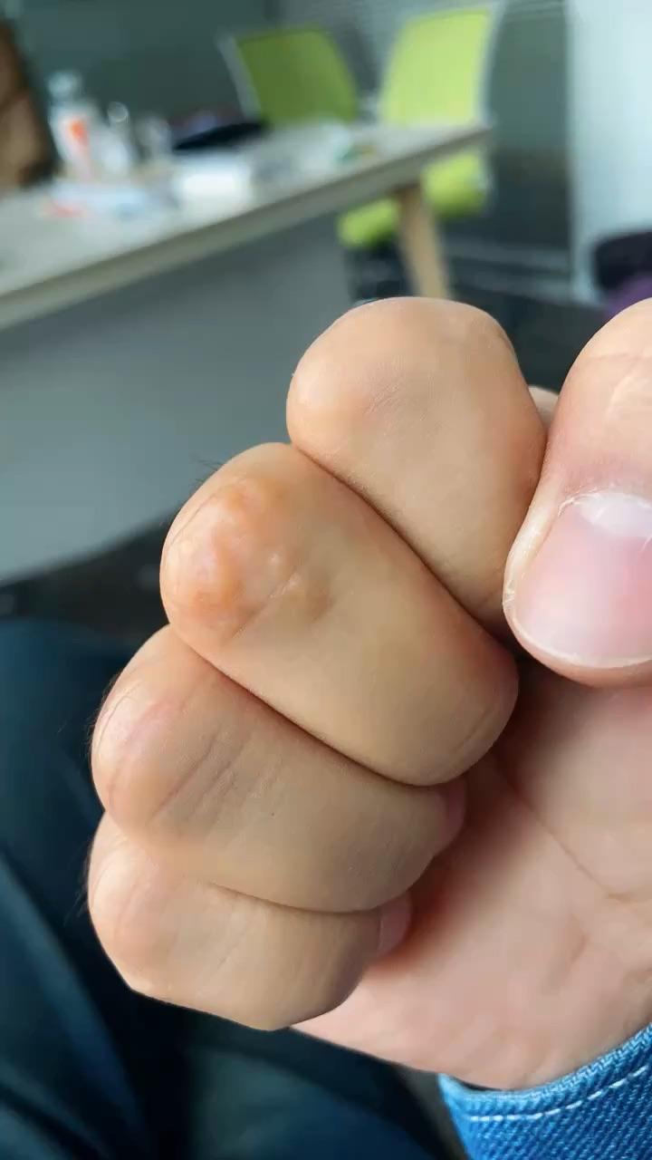 手指关节起包痒