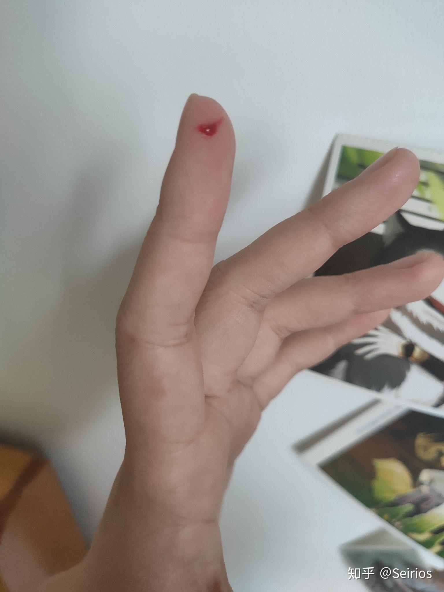 女生手指被刀割伤图片图片