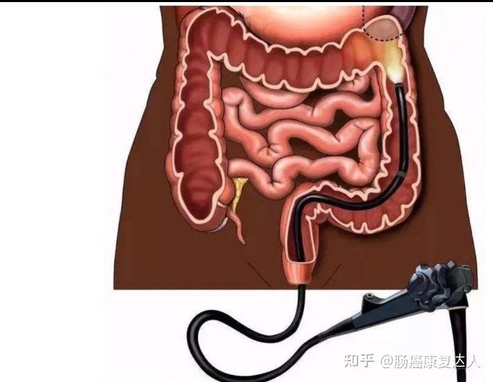 肠梗阻常见的症状有哪些? - 知乎