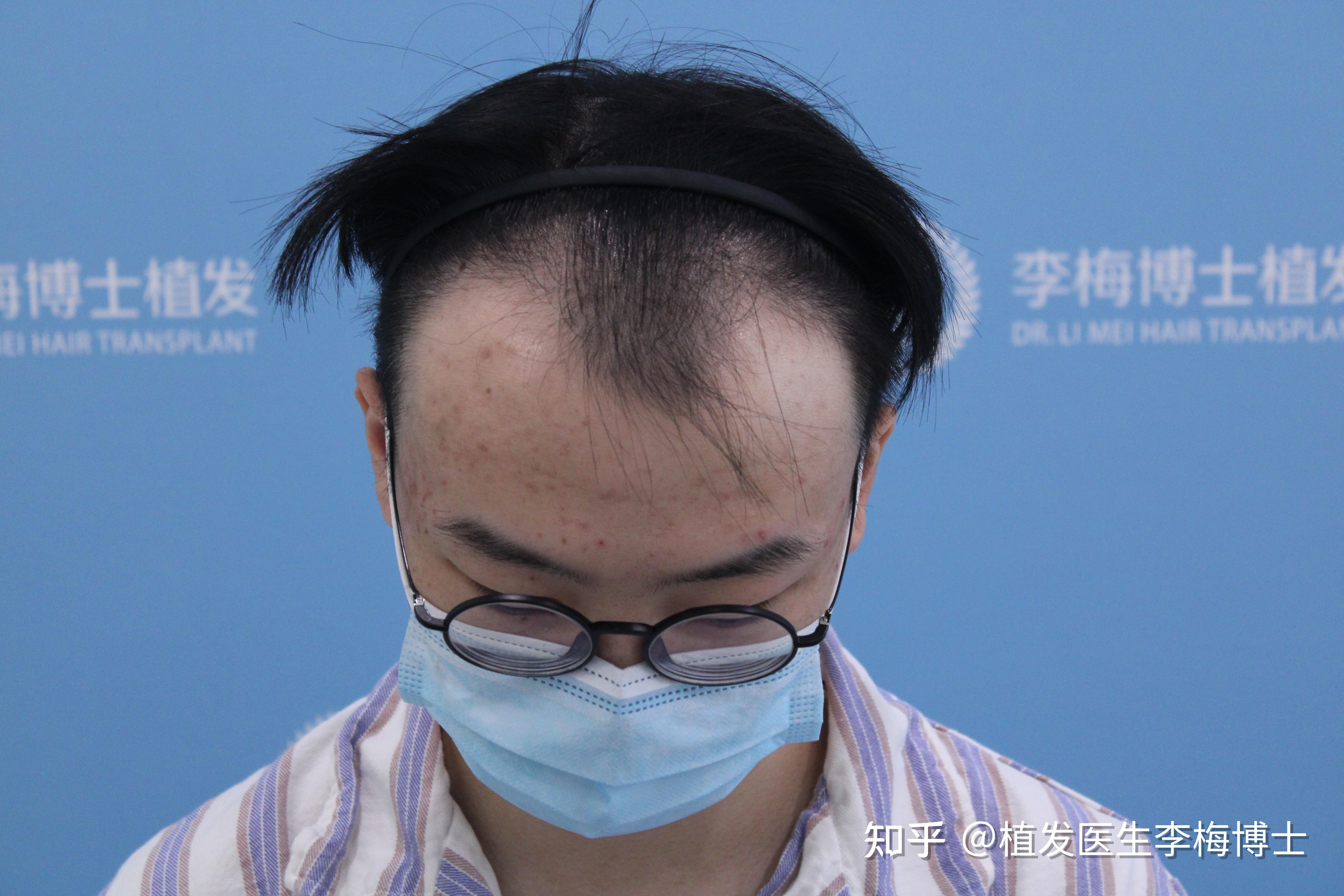 关于植发说说(关于植发的说说)