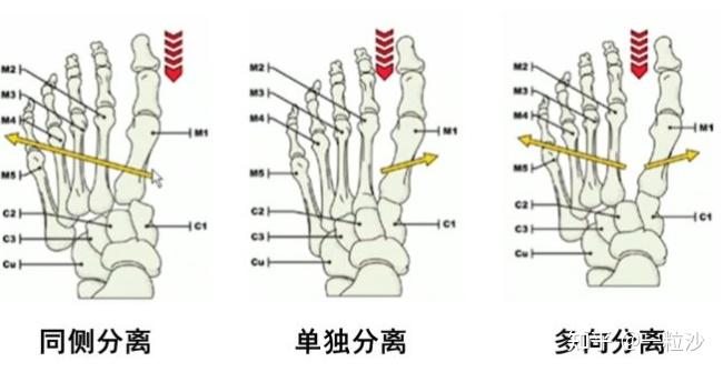Lisfranc 损伤实录 - 知乎