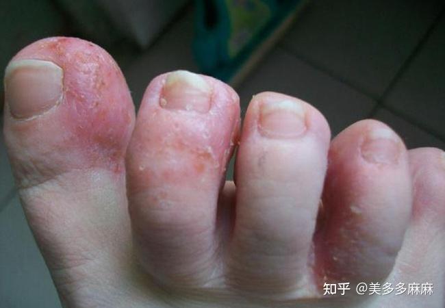 脚痒起水泡怎么办?