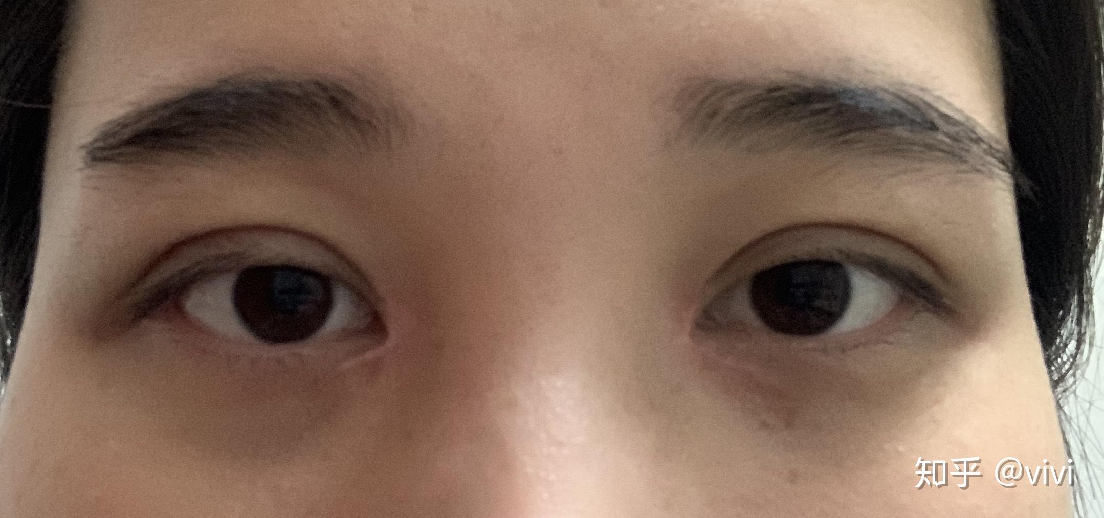 全切双眼皮一个月了现在两只眼睛不对称一只扇形一只