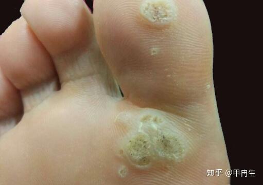 脚上小疙瘩长到“菜花”状,是跖疣? - 知乎