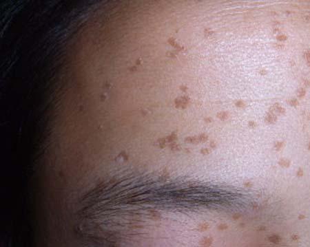 面部扁平疣有哪些治疗方法以下几点要谨记